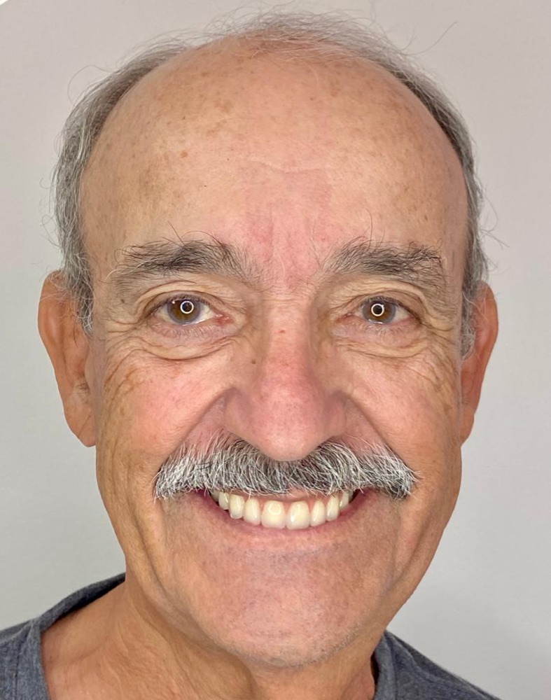 Paciente 3 depois do implante dentário